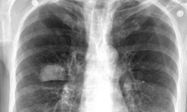 integragen-research-lung-cancer